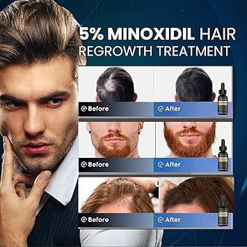 Suero para el crecimiento del cabello de minoxidil al 5%